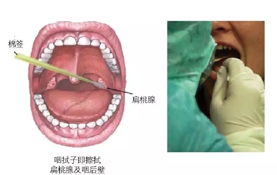 新型冠状病毒检测标本鼻咽拭子采样方法
