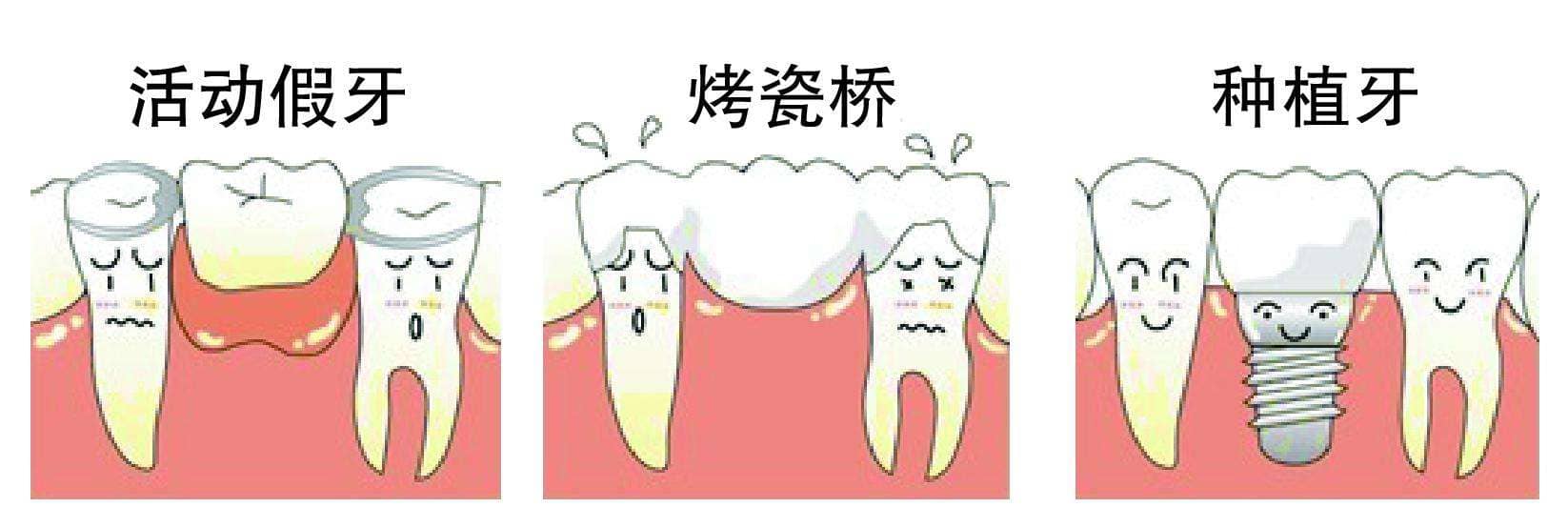 How To Repair Missing Teeth