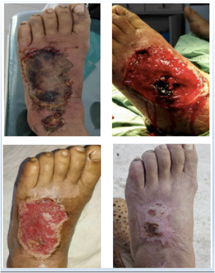 敷料"外用治疗20余天伤口愈合林女士,57岁左足背皮肤坏死淋巴癌手术